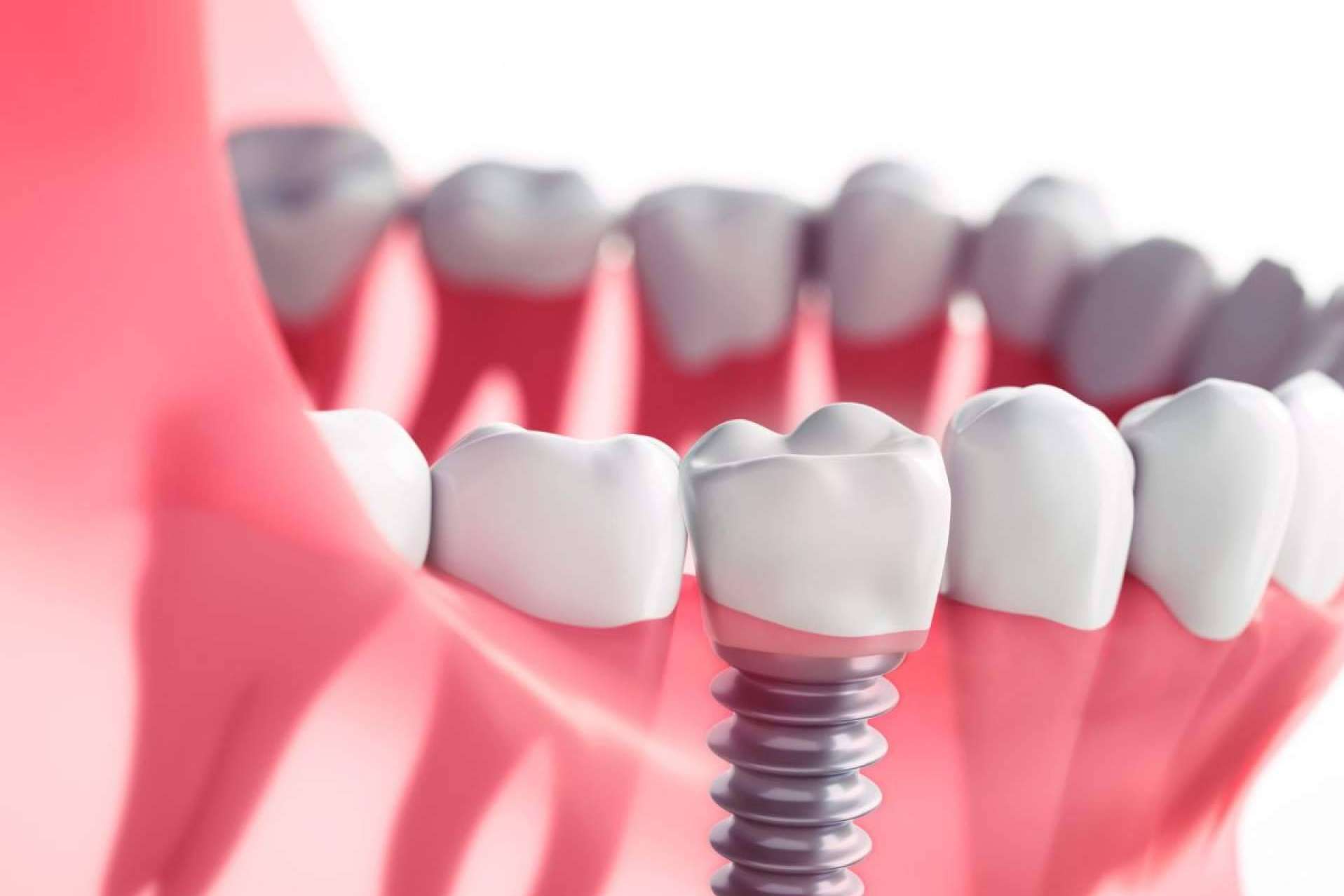 ¿Qué son los implantes dentales y para qué sirven?, por Prodental Santa Cruz