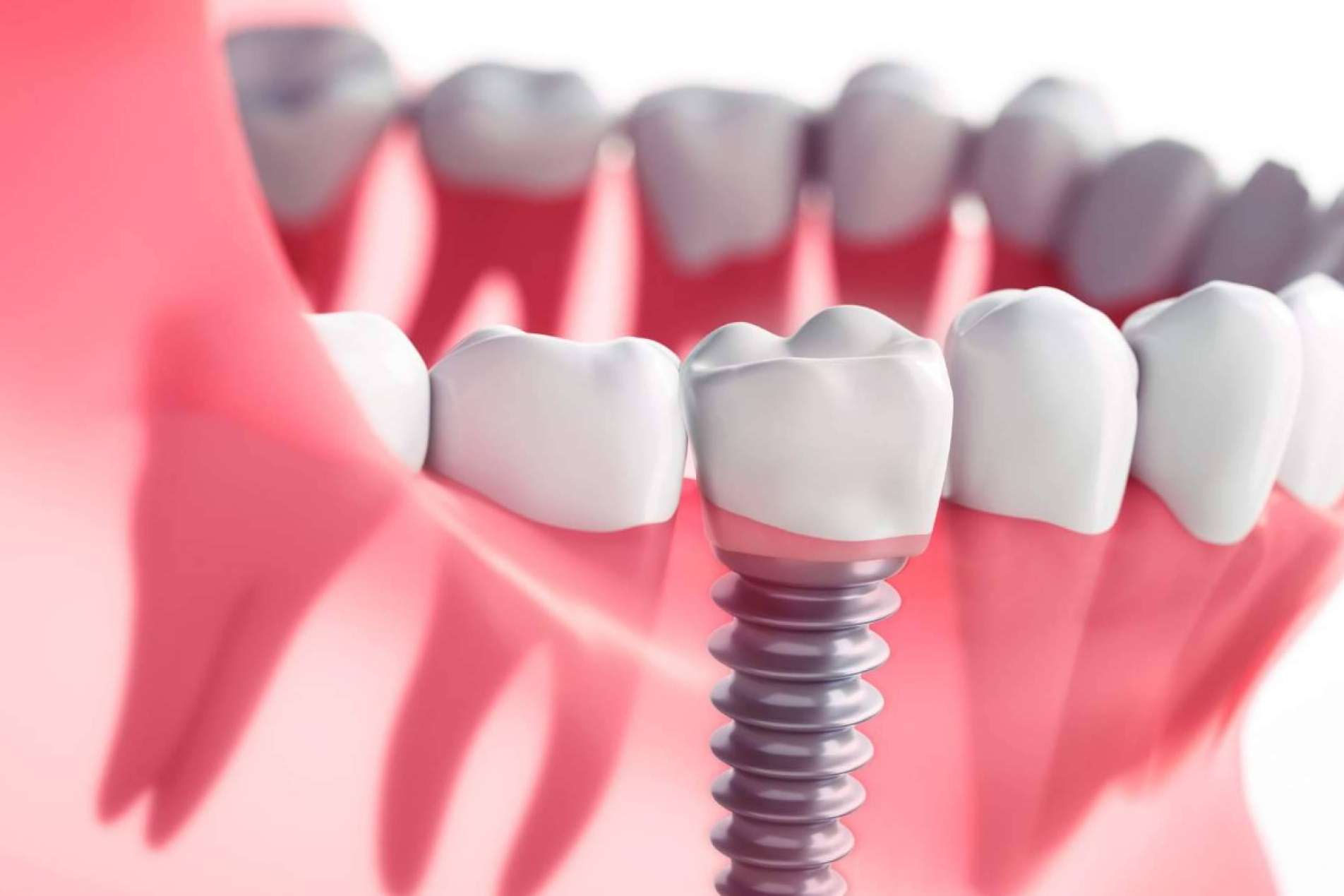 Encontrar la técnica de rehabilitación oral perfecta para cada caso de la mano de los expertos de la Clínica Dental Crespí & Gandía