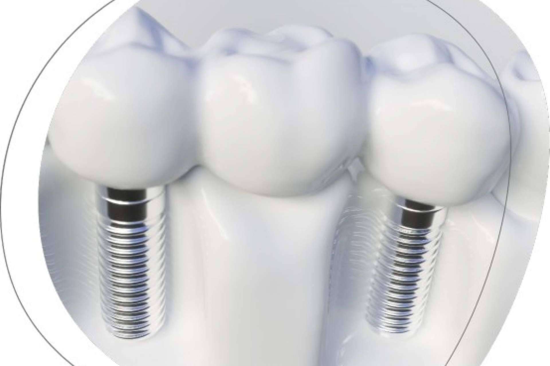 La Clínica Dental Agudo Rosa de Albacete es especialista en implantes dentales
