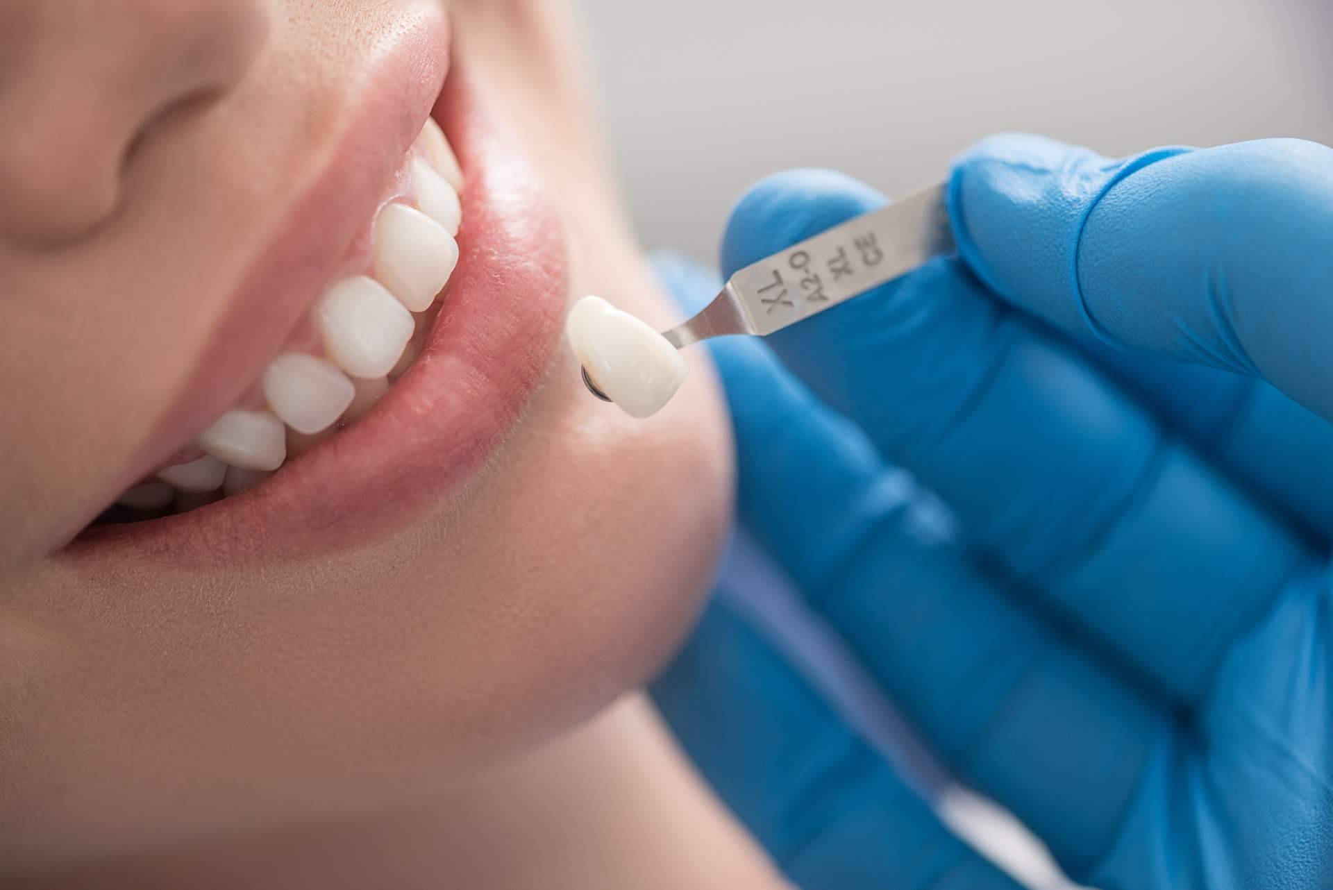 Clínica Dra. Elena Serrano, expertos en rehabilitación oral con coronas dentales