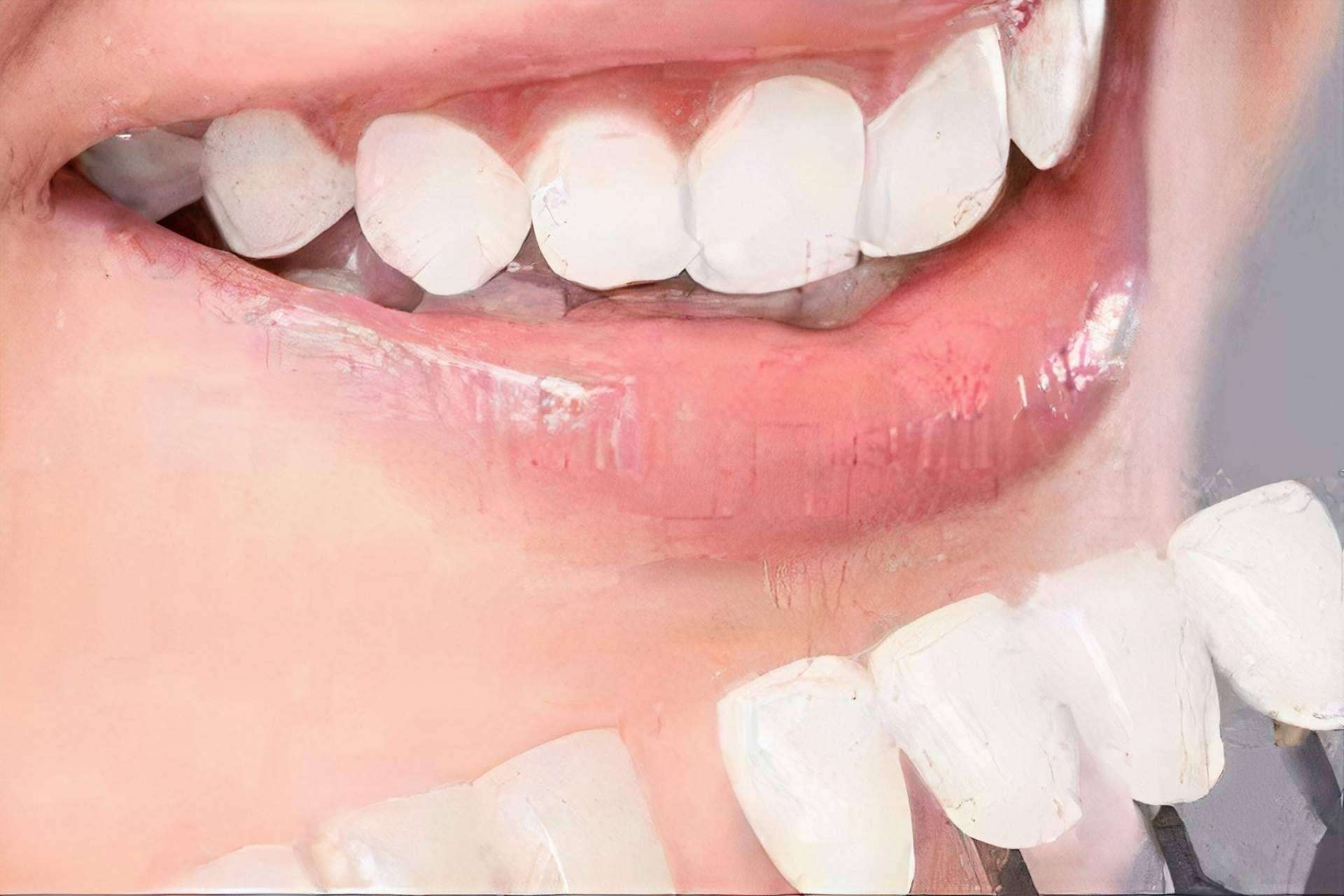 Blanqueamiento dental de calidad con Implant Clinics