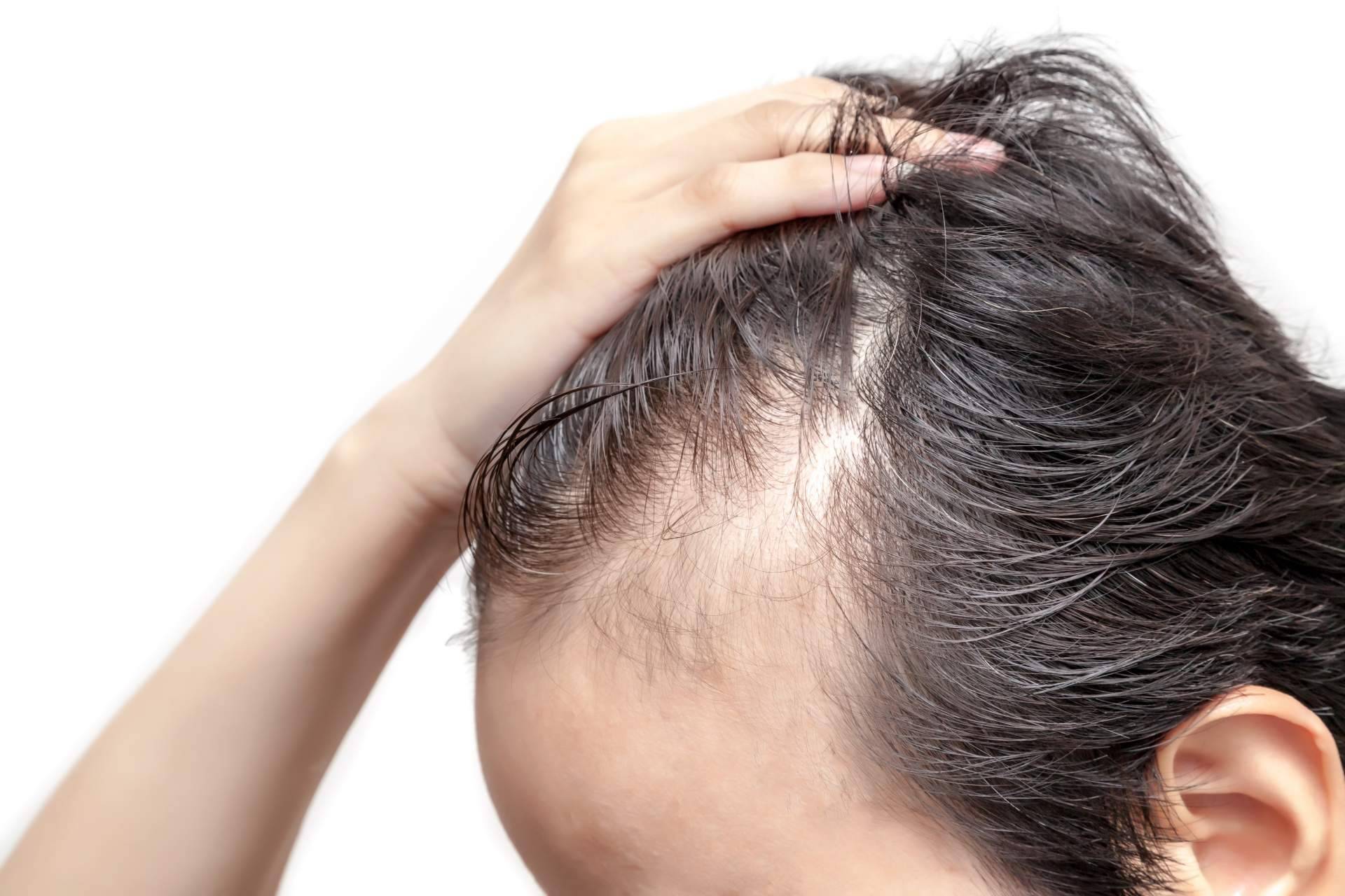 Tratar la alopecia androgénica con Saw Palmetto