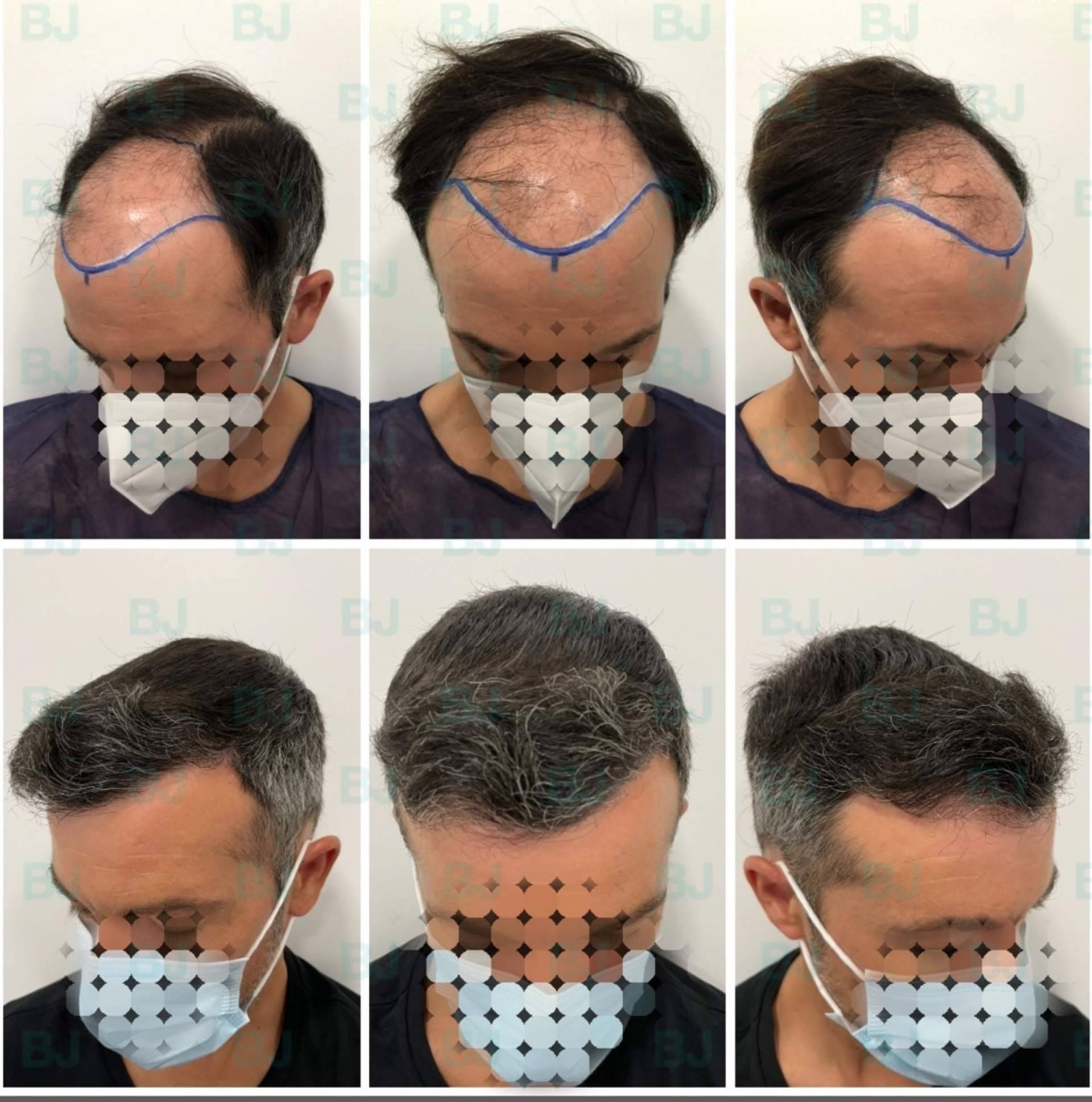 El injerto capilar en Barcelona más natural y denso ofrecido por el Dr. Bruno Jacobovski