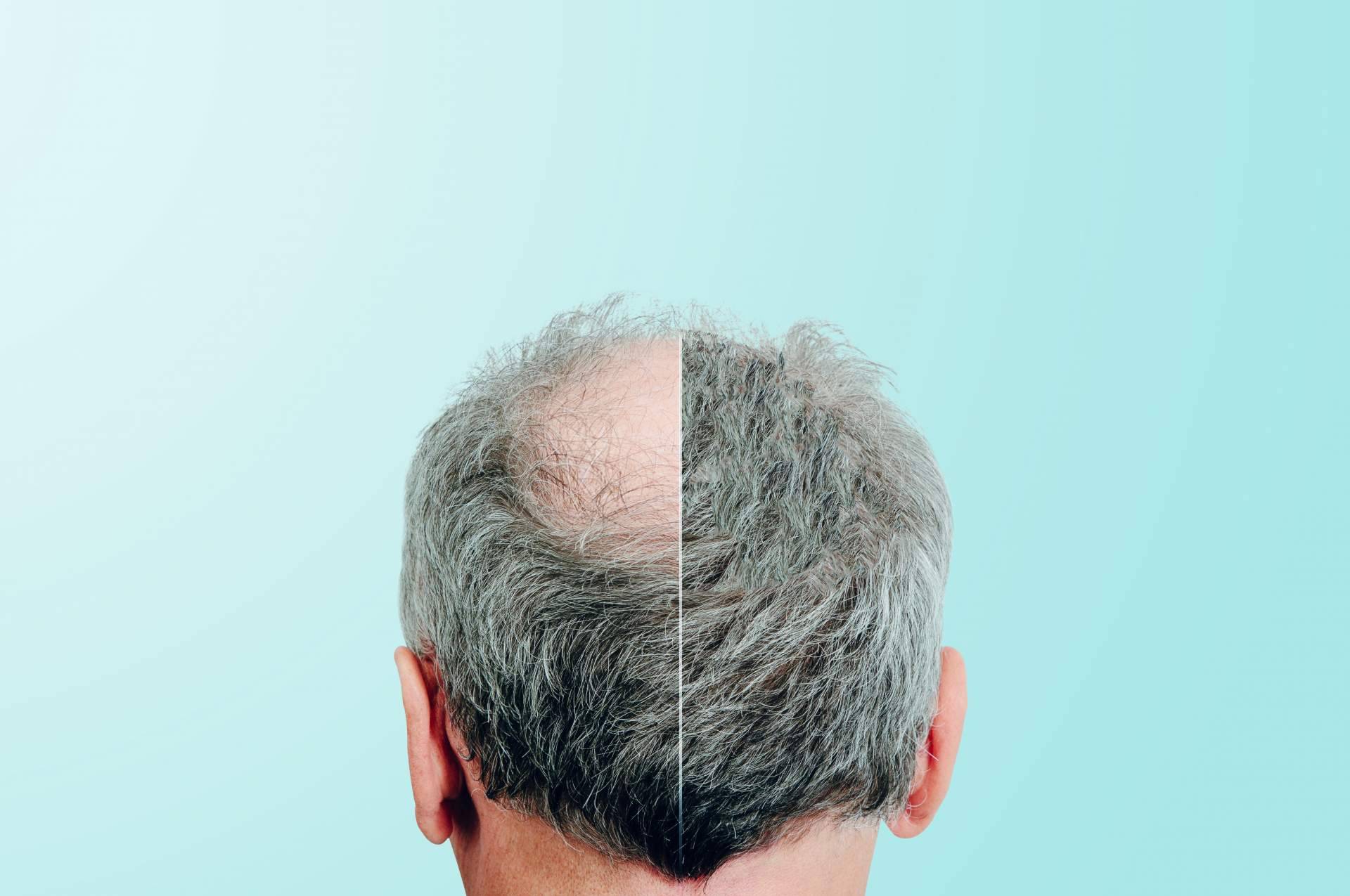 Nanofat, el tratamiento capilar de Clínica Tarrazo que pone fin a la alopecia